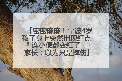 密密麻麻！宁波4岁孩子身上突然出现红点！连小便都变红了……家长：以为只是摔伤